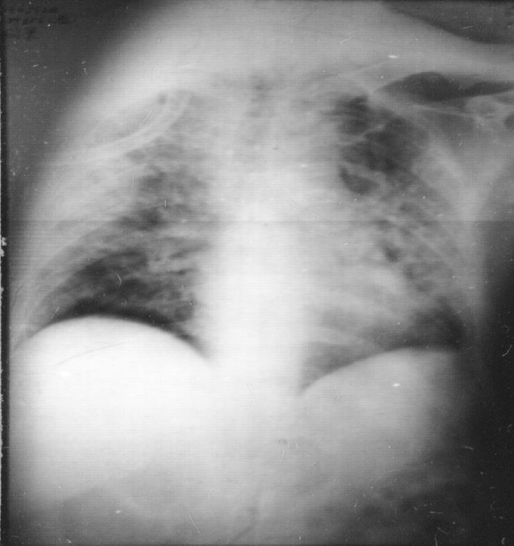 肺结核防控诊疗方案,成功治疗肺结核病的关键