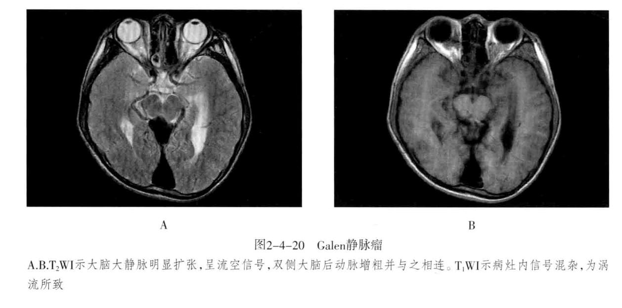 颅内血管轻度狭窄诊断标准,颅内血管先天变异影像