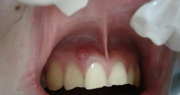 牙龈长脓包挤破又长回来,牙龈长脓包弄破了第二天又有脓