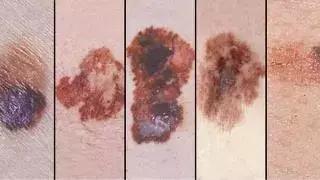 人身上长的黑痣瘊子能变癌症吗,手上长小黑痣会是癌症信号吗