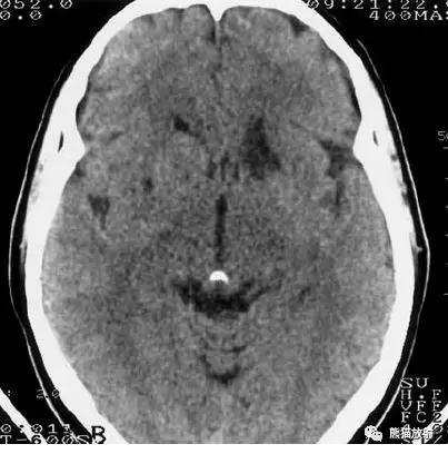 脑梗死丨演变、血供区域分布、CT表现