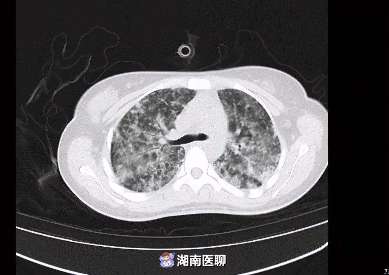 只因喝了一口田间水！花季女孩“感冒”发热，竟致中毒性休克