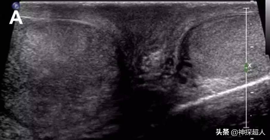 男性“蛋蛋”痛,必须引起重视,特别是一侧突发痛