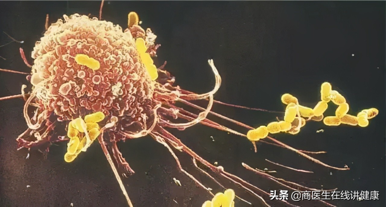 几个月内形成的浸润癌易复发么,浸润癌恶性