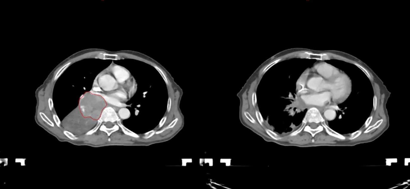 商陆治疗肺癌晚期,硼中子治疗晚期肺癌
