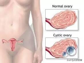 卵巢巧克力囊肿癌变的10个征兆,妇科检查时能查出卵巢囊肿吗