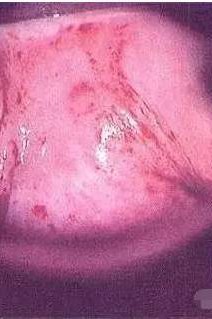 我今年57岁外阴瘙痒用什么药,外阴瘙痒分泌物检查正常怎么回事