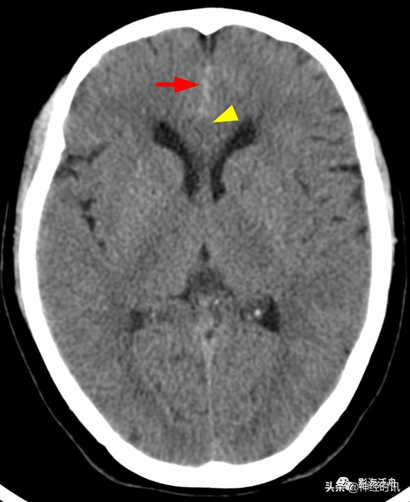 蛛血的临床表现,蛛血ct表现
