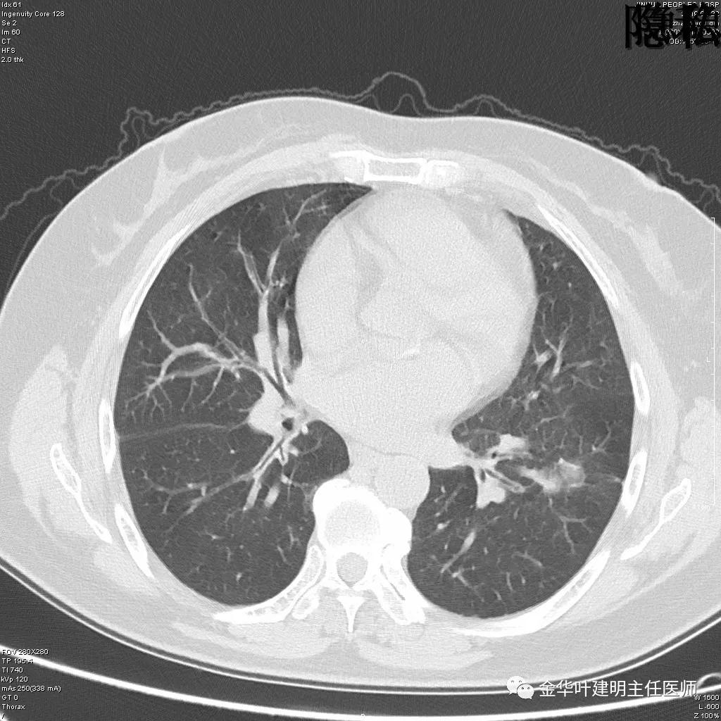 左肺下叶恶性病变,左肺上叶和下叶都有血管畸形