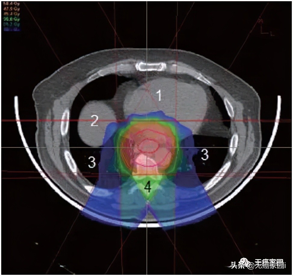 质子治疗消化道肿瘤,质子重离子治疗肠胃瘤