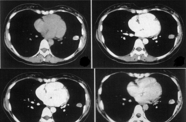 花甲老人身患“肺结核”多年,身体却很康健,是什么原因