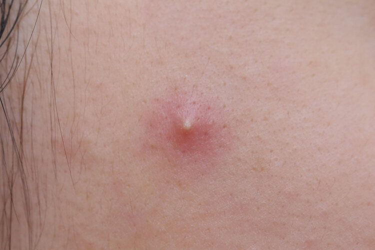 两块钱的红霉素软膏有什么用途,红霉素软膏6大用途5个注意事项