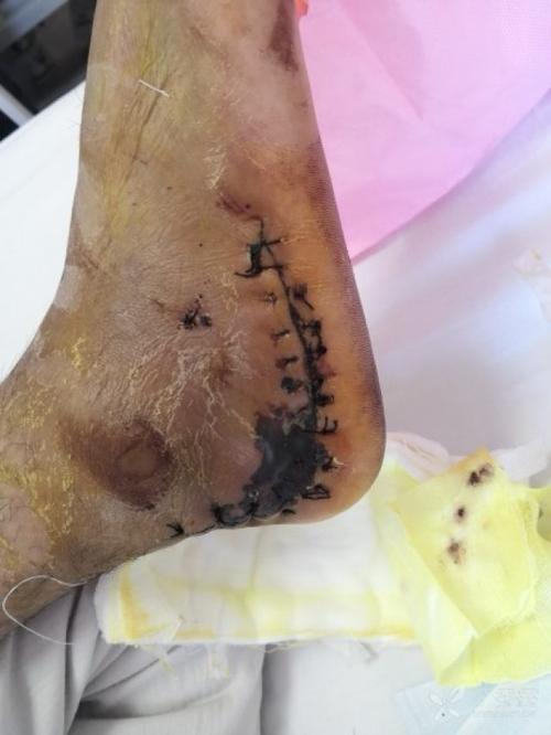 高处跌落脊椎骨折需要手术吗,高处坠落导致骨盆骨折怎样治疗