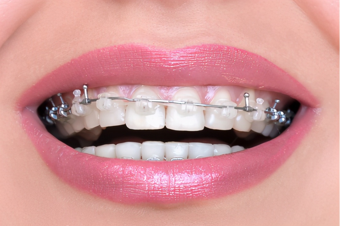 摘牙套后脸胖了,摘牙套后发现效果不好