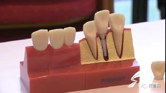 种植牙价格虚高监管出手整治,种植牙乱象调查