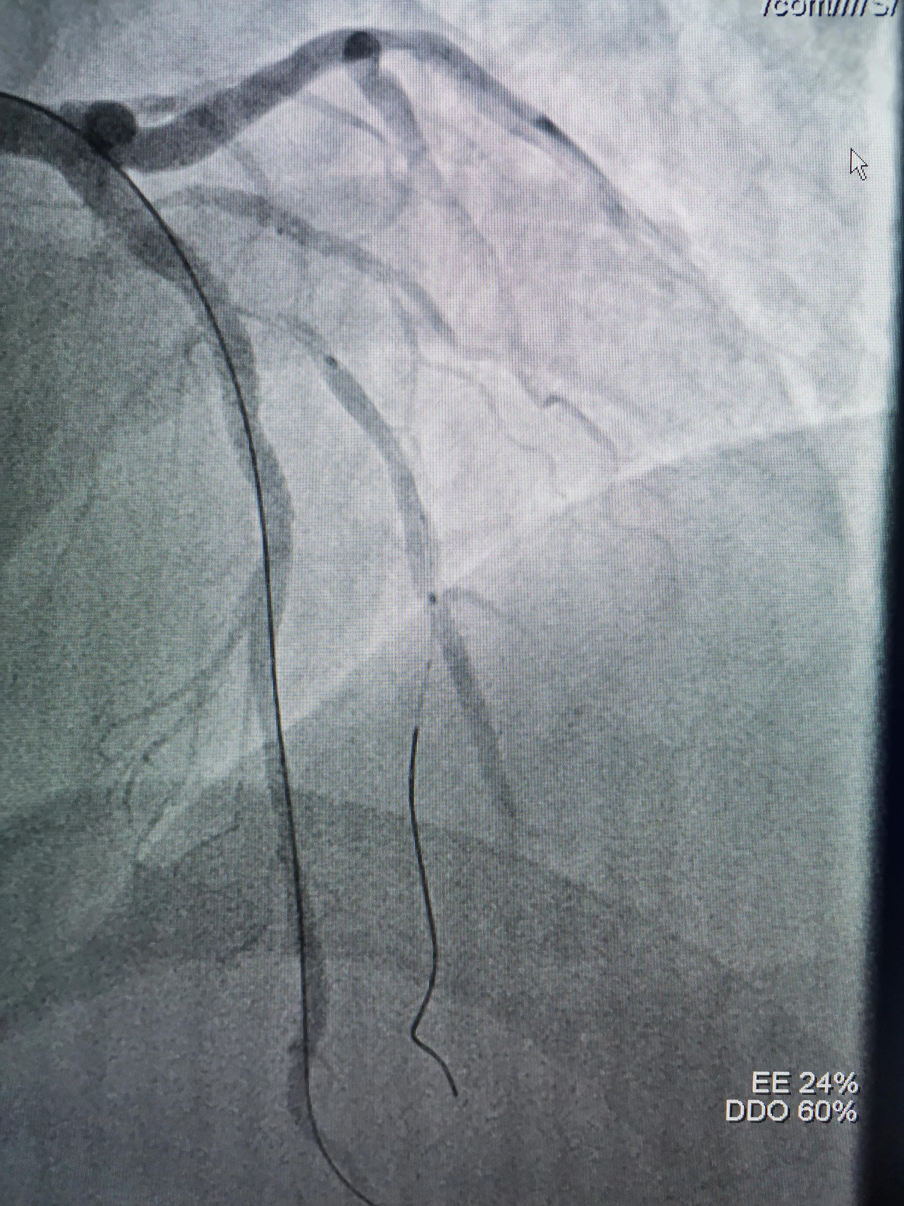 atp术式治疗冠脉分叉病变,冠脉分叉处堵塞能治吗
