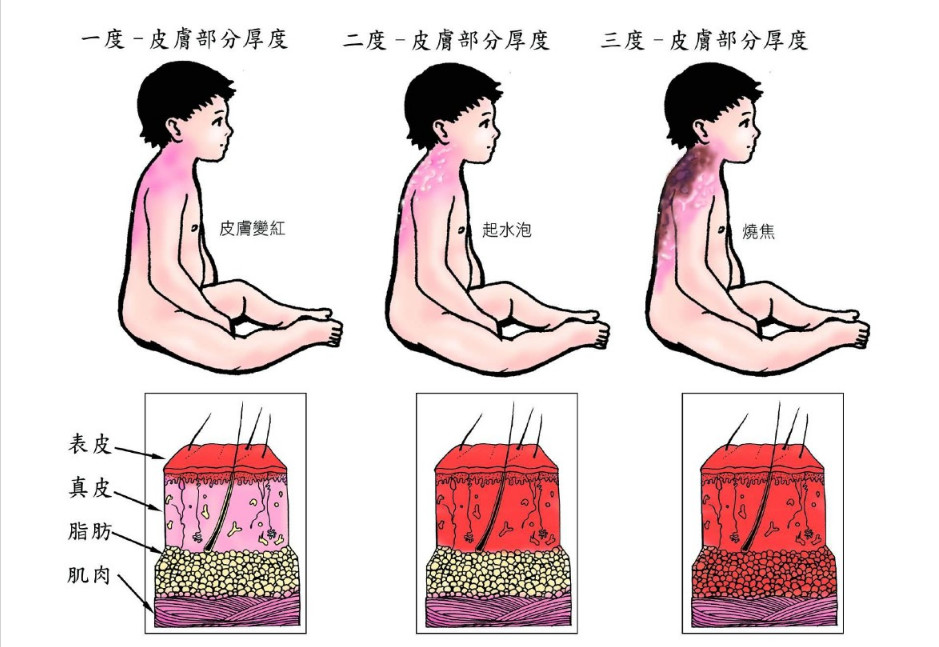 烧烫伤小科普,高温烫伤处理方法以及注意事项