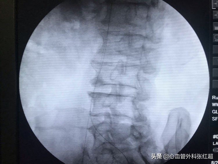 外周血管外科治疗范围,外周血管介入治疗疗程