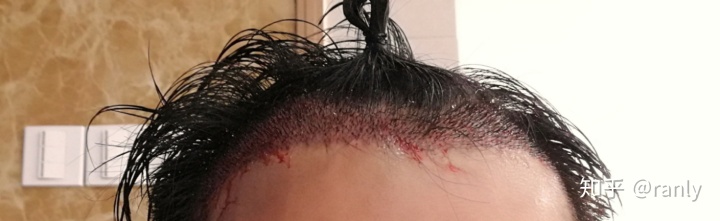 植发日记是什么,植发日记vlog第六天