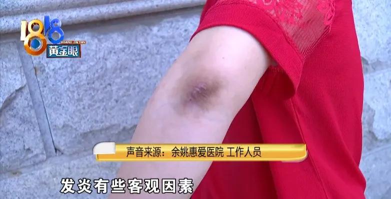 鑲樼毊鐐庢墦浜嗗嚑閽堝悗婧冪儌,鎵嬭倶鐨値娌荤枟