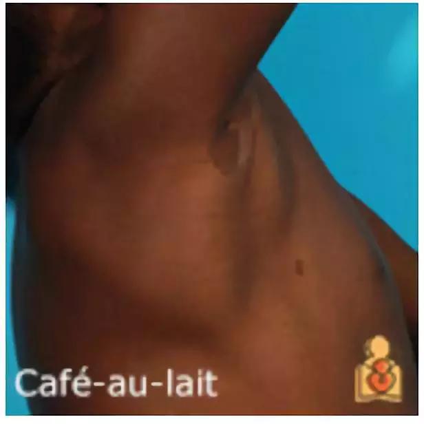 为什么宝宝出生屁股会有青胎记,宝宝出生屁股上有淤青是什么原因