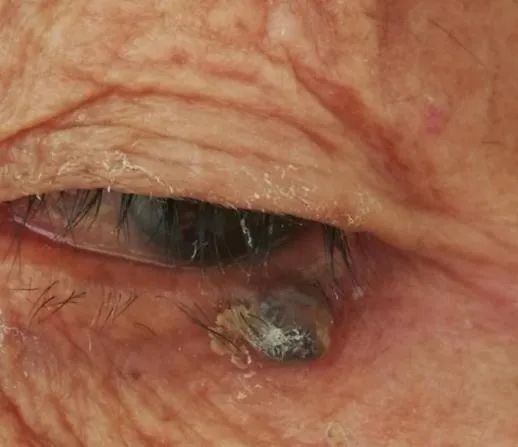 眼整形修复权威科普,科普眼整形手术是个什么手术多图