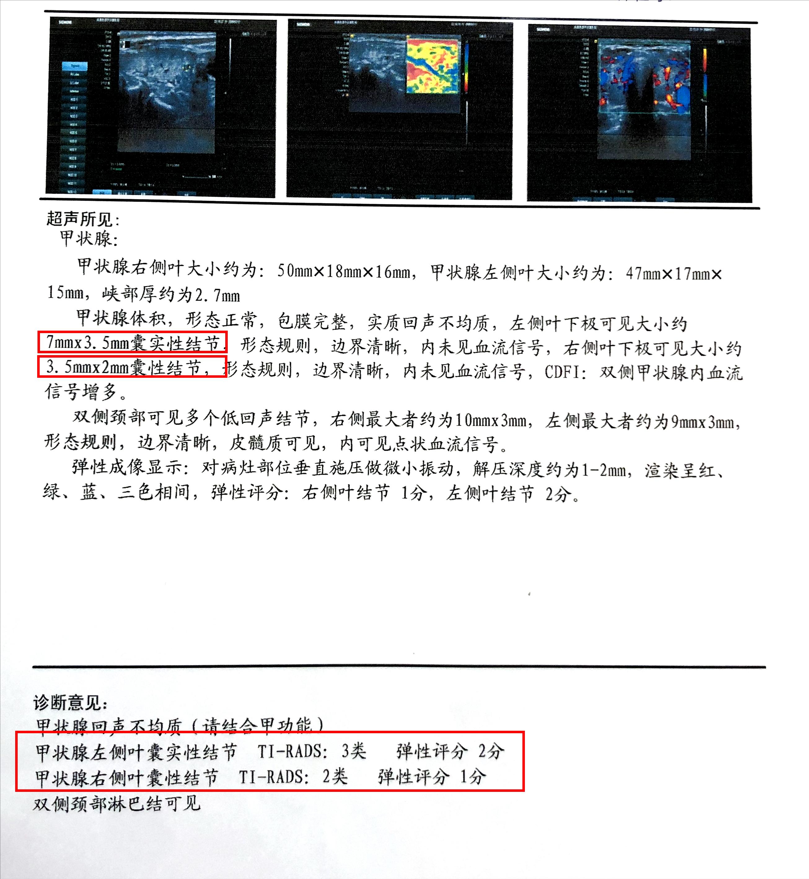 甲亢眼睛突真实案例,甲亢现状