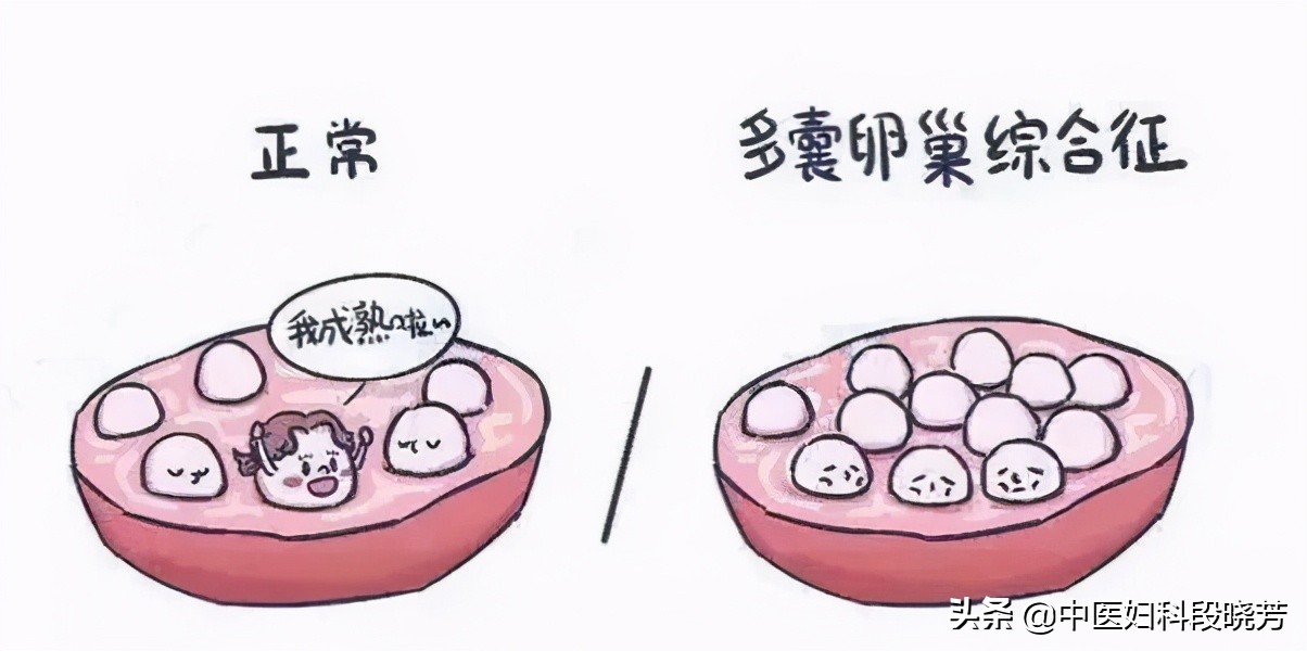 多囊卵巢卵泡长多了会怎么样,多囊卵巢促排卵子质量不好怎么办