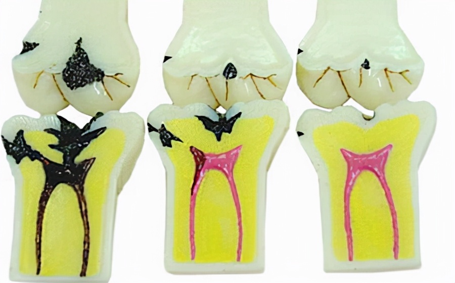 根管治疗后,牙齿还能用多久?听良心牙医讲解