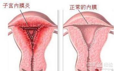 绝经后出血警惕四种疾病,绝经后出血当心卵巢癌