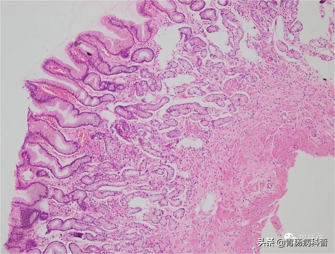 萎缩性胃炎伴肠化轻度能治愈吗,萎缩性胃炎伴肠化可以治愈吗