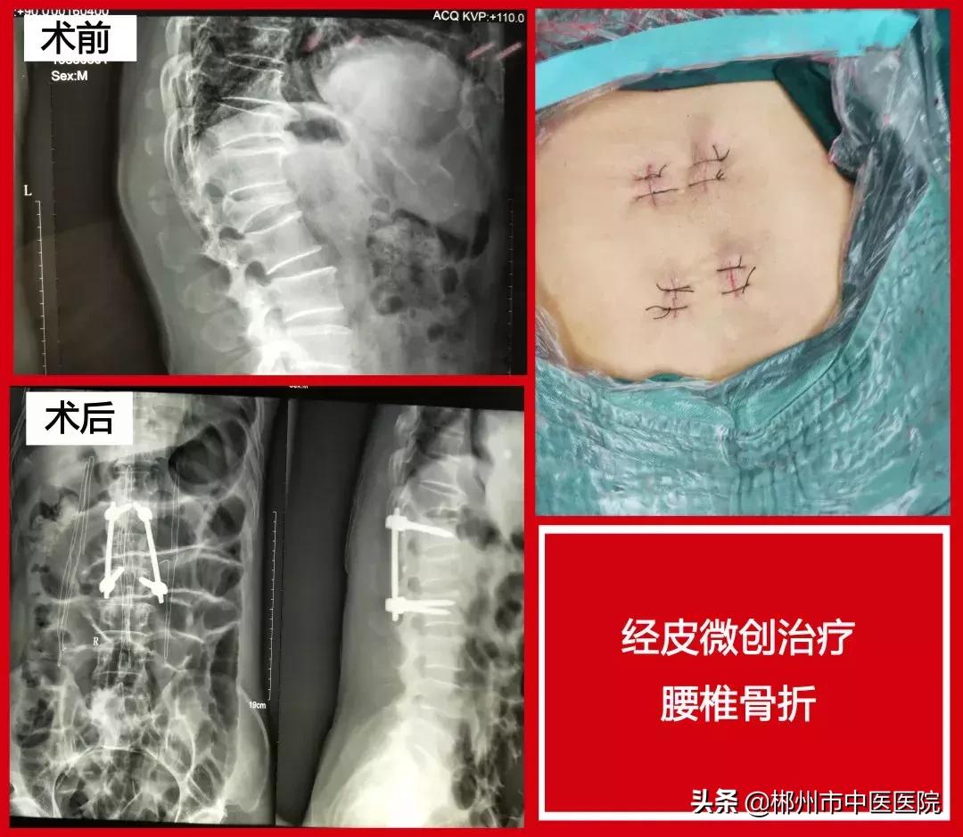 【谈骨论筋】脊柱微创为患者“撑腰”