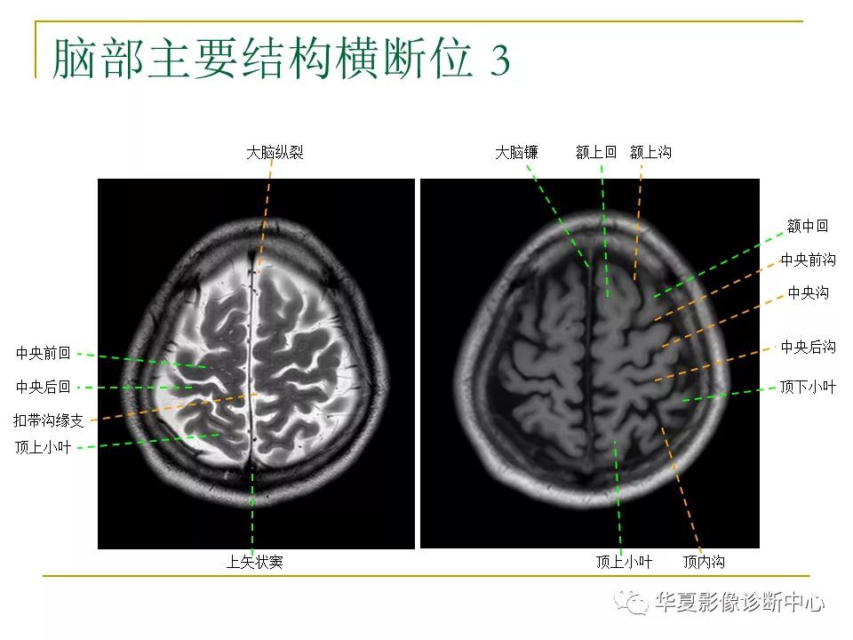 中国人脑立体定向mri应用解剖图谱,脑mri示意图