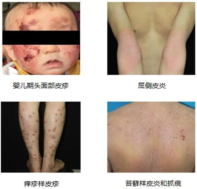 皮炎湿疹瘙痒跟肺有关系吗,皮肤痒各种皮炎湿疹