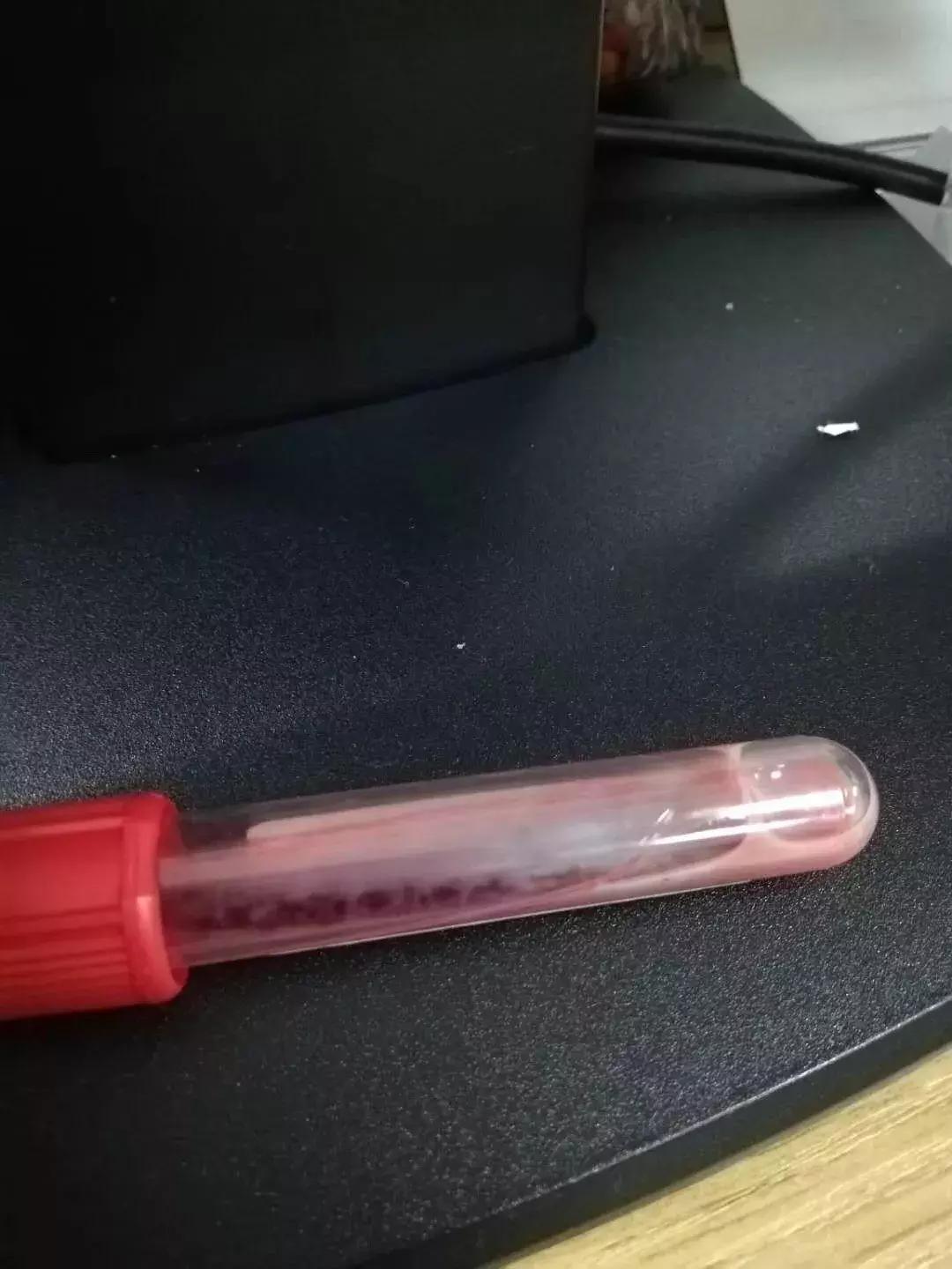 孕32周孕妈腹痛抽出了“油脂血”,竟是与饮食油腻有关?