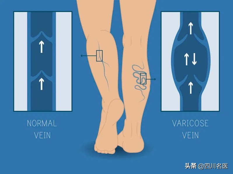 华西专家讲静脉曲张,16岁少年得静脉曲张吗