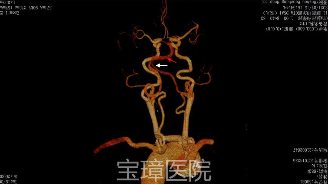 神经内镜微创手术治疗三叉神经痛,微血管减压术治疗三叉神经后遗症