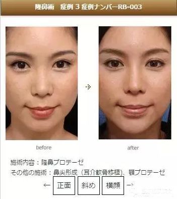 日本整容真的很好吗,日本整容vs韩国整容图片对比
