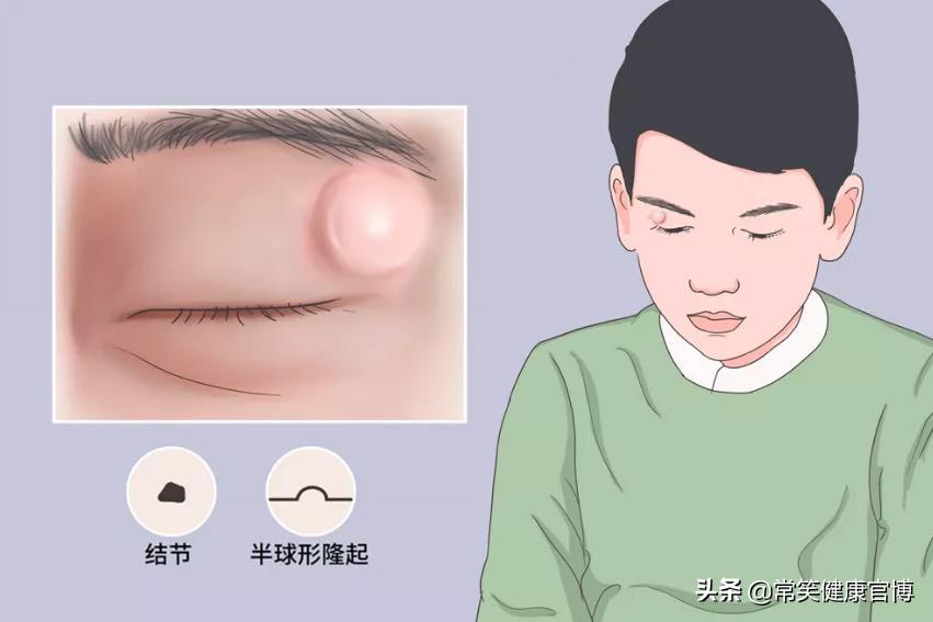 全身皮下能摸到小疙瘩,身上皮下摸到小疙瘩