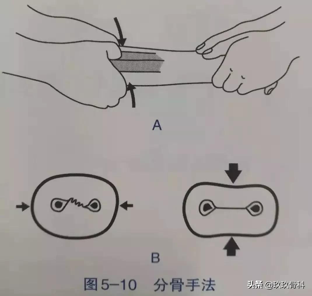 骨折手法整复术多少钱,骨折恢复手法视频教程
