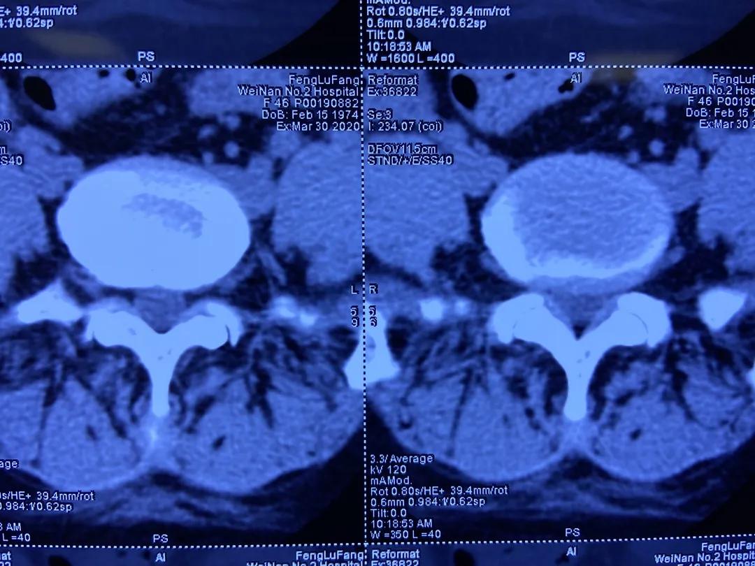 渭南治腰间盘突出哪家最好,脊柱神经外科手术