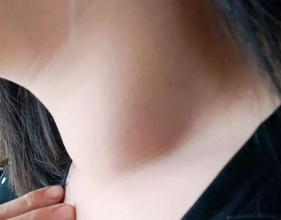 看懂化验单判断甲状腺结节良恶性,甲状腺结节微创和开刀的区别