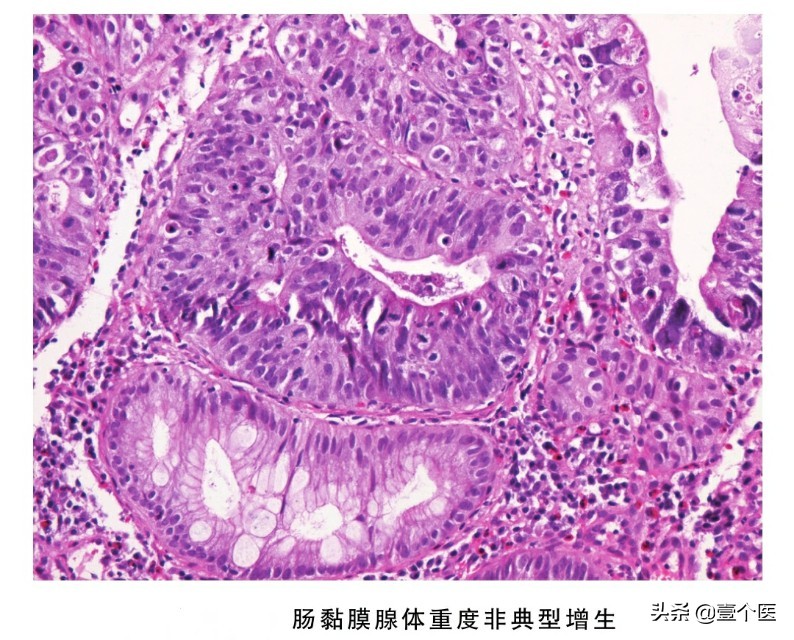 癌前病变非典型增生解释,病理出现原位癌和浸润性癌