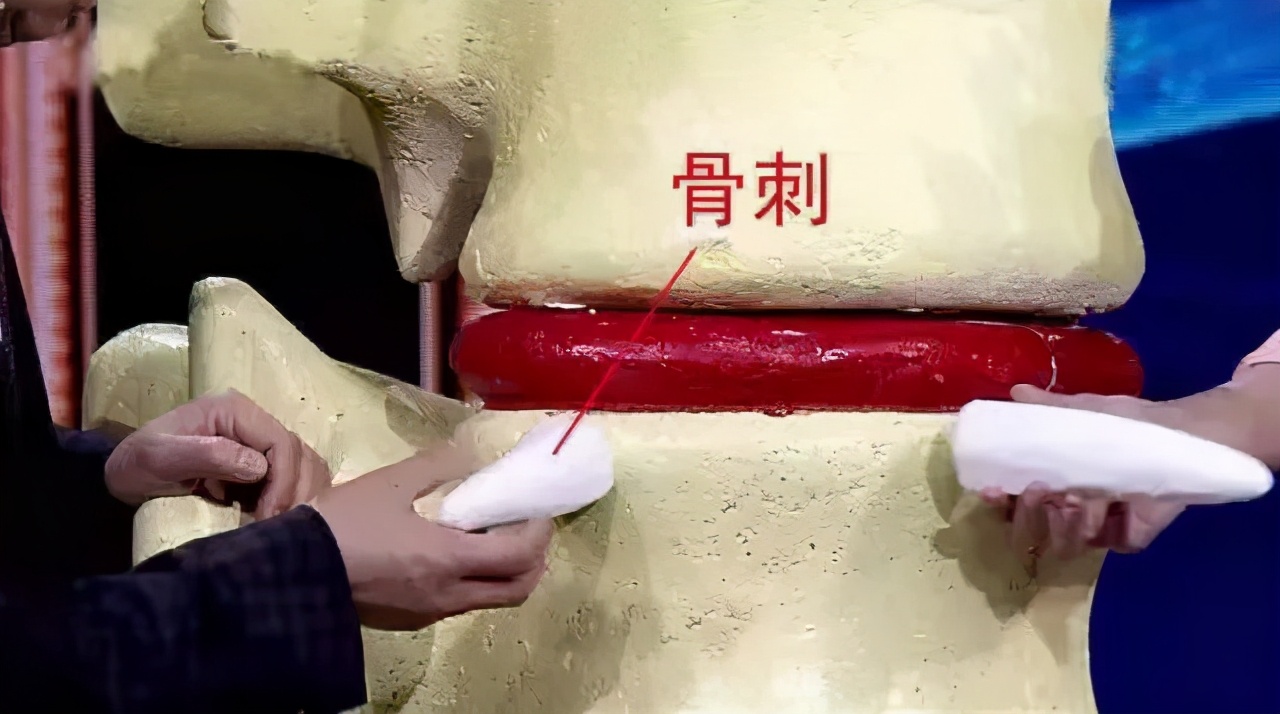 骨刺致命吗,有了骨刺也别怕几个方法消除它