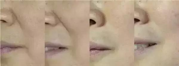 鼻唇沟深做什么手术可以改善,除了填充怎样改善鼻唇沟塌陷