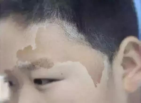 常见皮肤色斑有哪些怎么鉴别,面部色斑的鉴别诊断视频