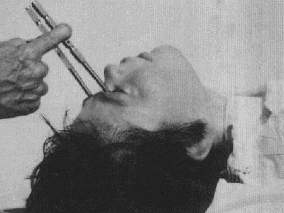 拔牙和切除内脏，能治精神病？精神病学史的发展，总是这么雷人