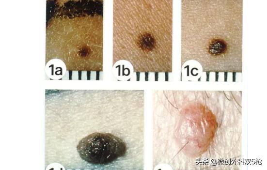 身上黑痔小心要了命！掌握ABCDE原则，教你肉眼判断黑色素瘤