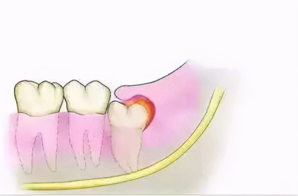 这些都能导致严重的牙疼，可以这样治疗？#雅悦齿科#