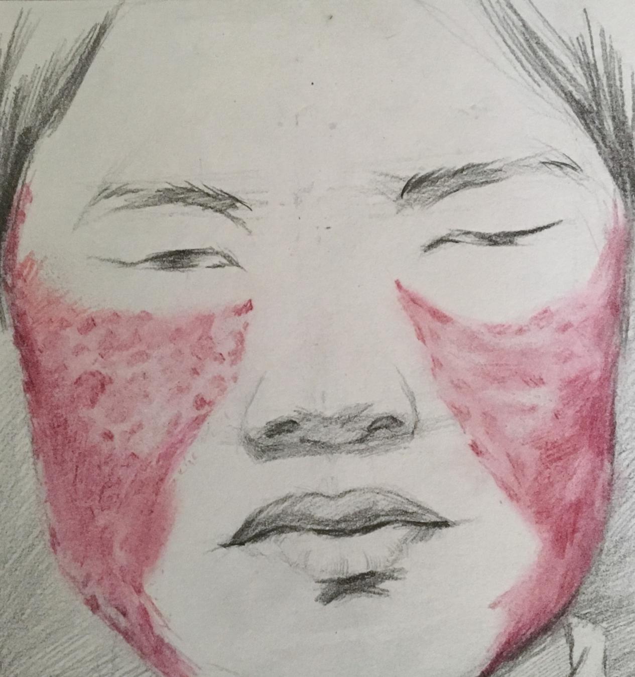 口腔黏膜溃疡反复发生吃什么药,反复口腔溃疡看风湿科有没有用